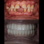 Before and after Dental Implants