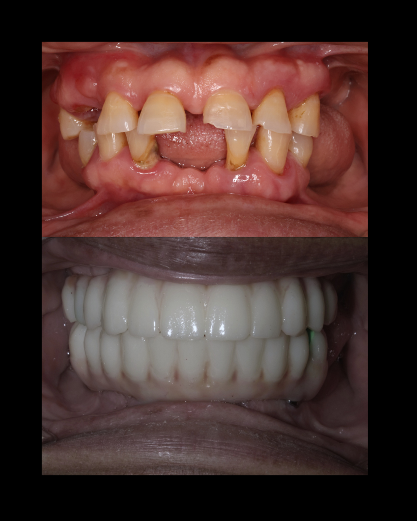 Before and after Dental Implants