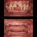 Before and after Dental Implants