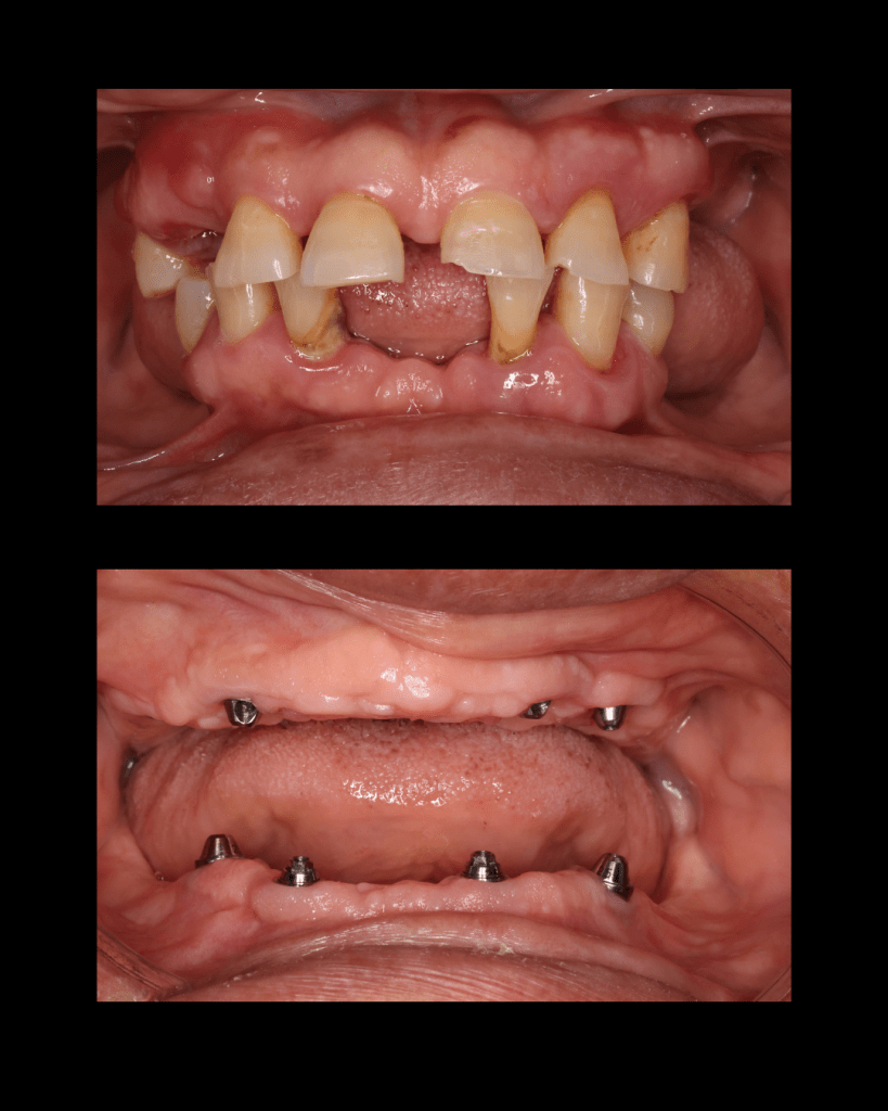 Before and after Dental Implants