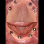 Implants
