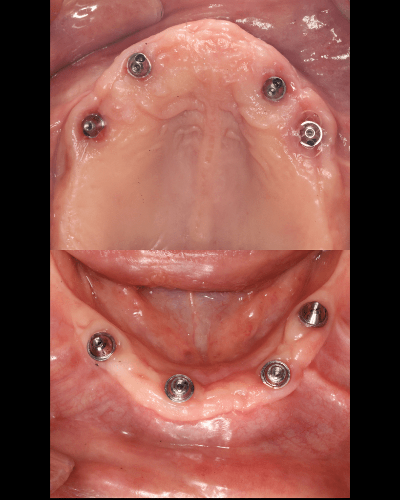 Implants