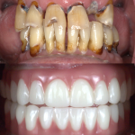 Before and after Dental Implants
