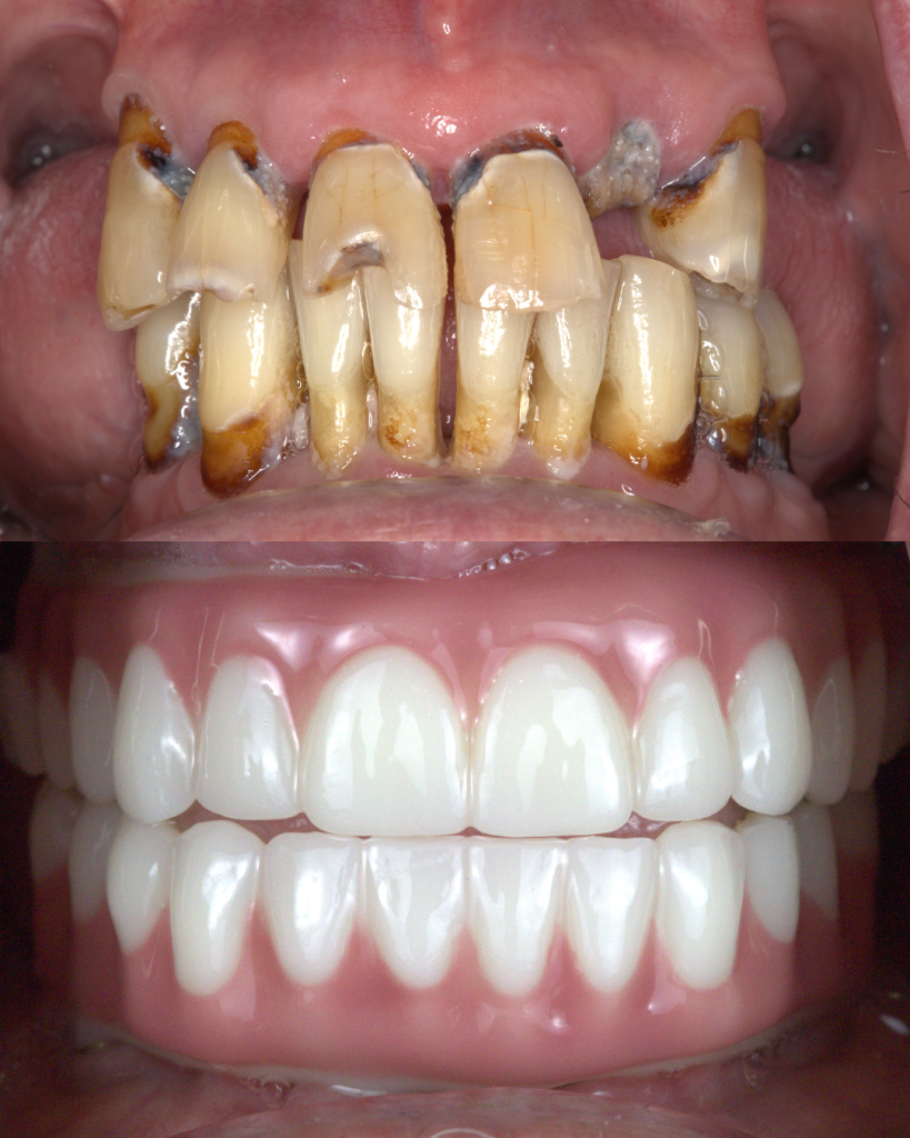 Before and after Dental Implants