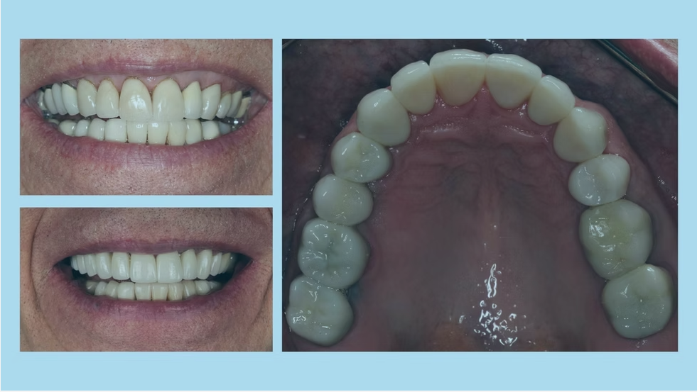 Before and after 1