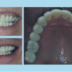 Before and after 1