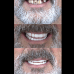 Before and after Dental Implants