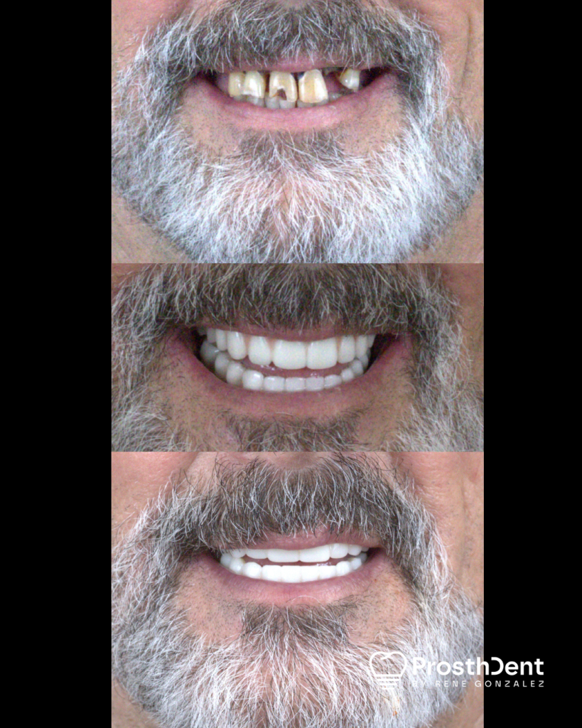 Before and after Dental Implants