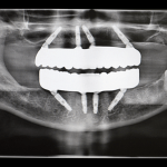 Implants
