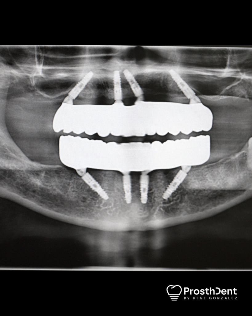 Implants
