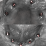 Implants