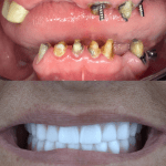 Before and after Dental Implants
