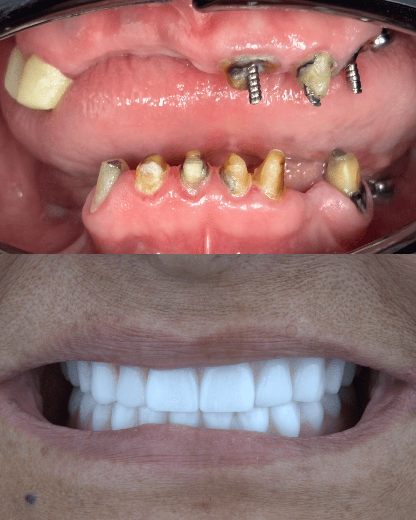 Before and after Dental Implants