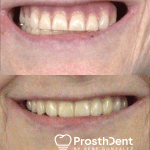 Before and after Dental Implants