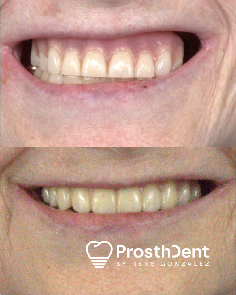 Before and after Dental Implants