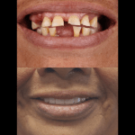Before and after Dental Implants