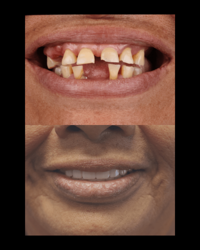 Before and after Dental Implants