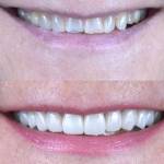 Dental crowns before and after photo