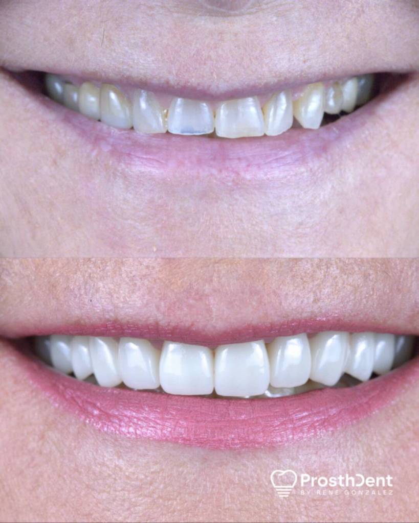 Dental crowns before and after photo