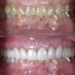 Dental crowns before and after photo