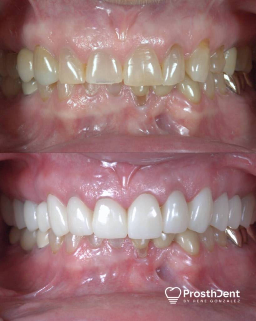 Dental crowns before and after photo