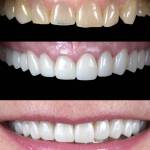 Dental crowns before and after photo