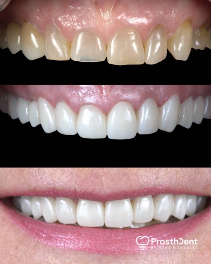 Dental crowns before and after photo