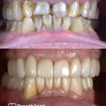 Dental crowns before and after photo