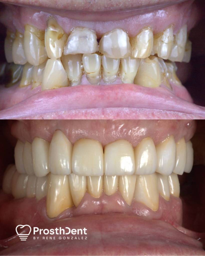 Dental crowns before and after photo