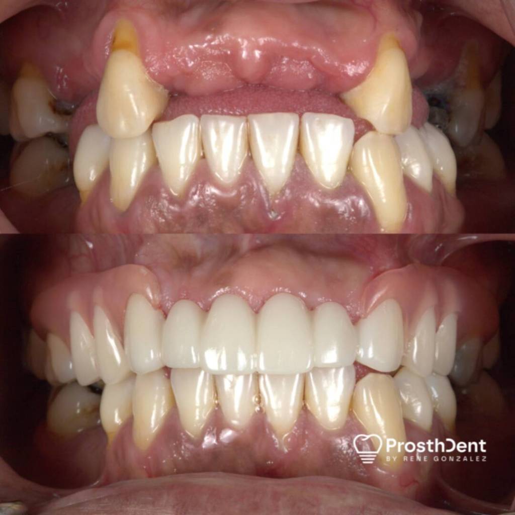 Dental crowns before and after photo