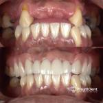 Dental crowns before and after photo