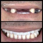 Dental crowns before and after photo