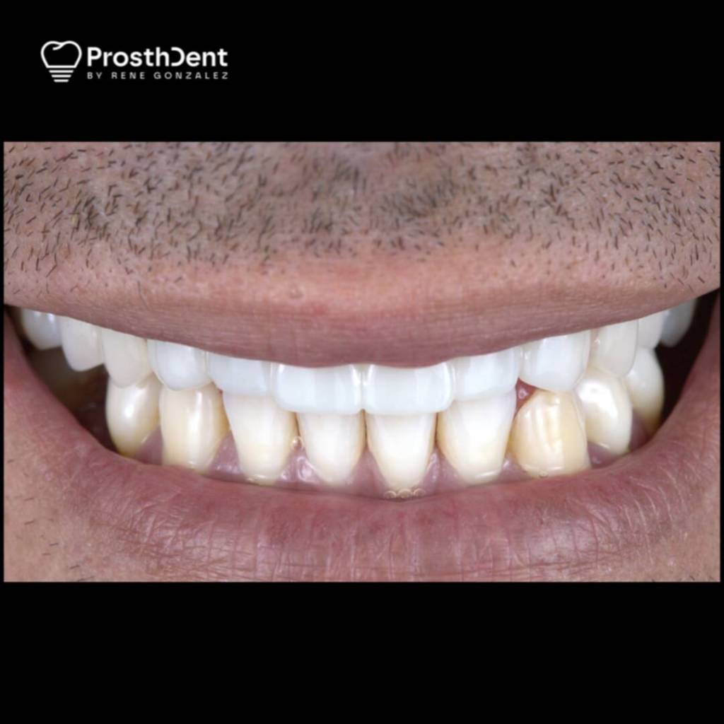 Dental crowns after photo