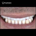 Dental crowns after photo