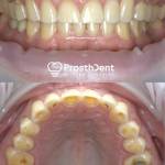 Dental crowns before and after photo