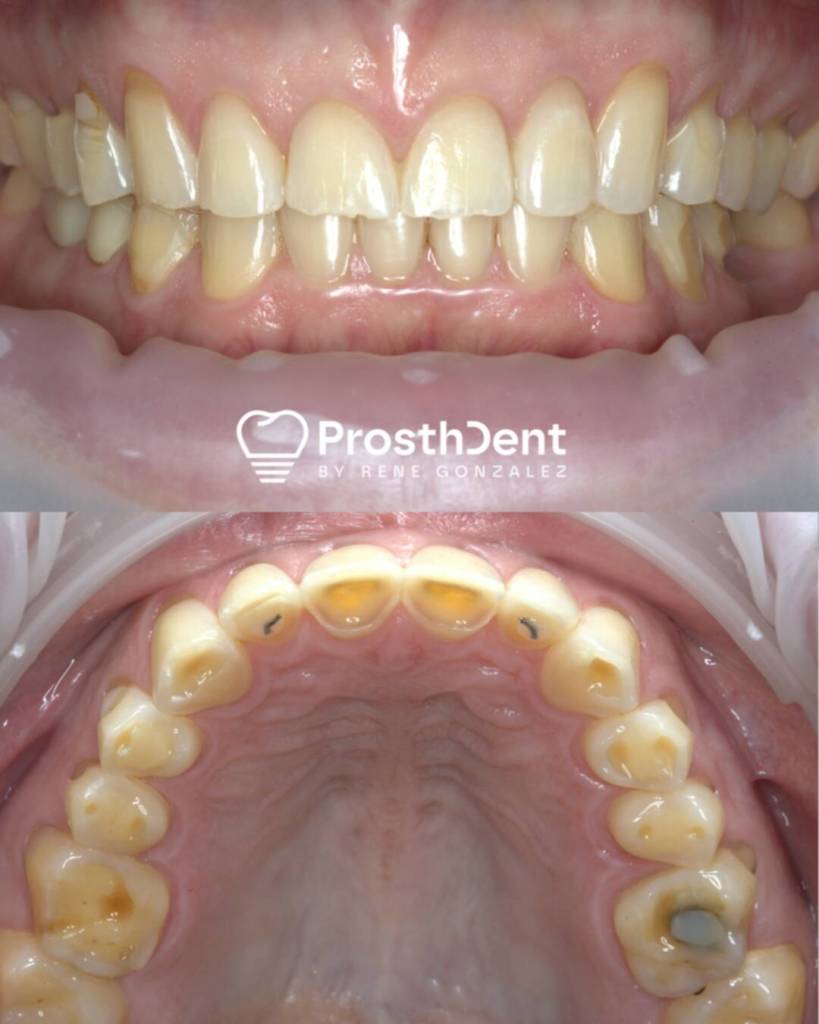 Dental crowns before and after photo