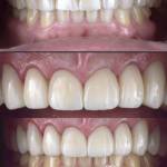 Dental crowns before and after photo