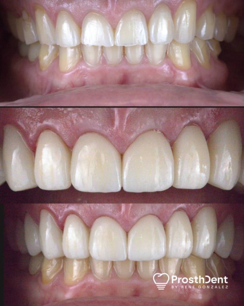 Dental crowns before and after photo