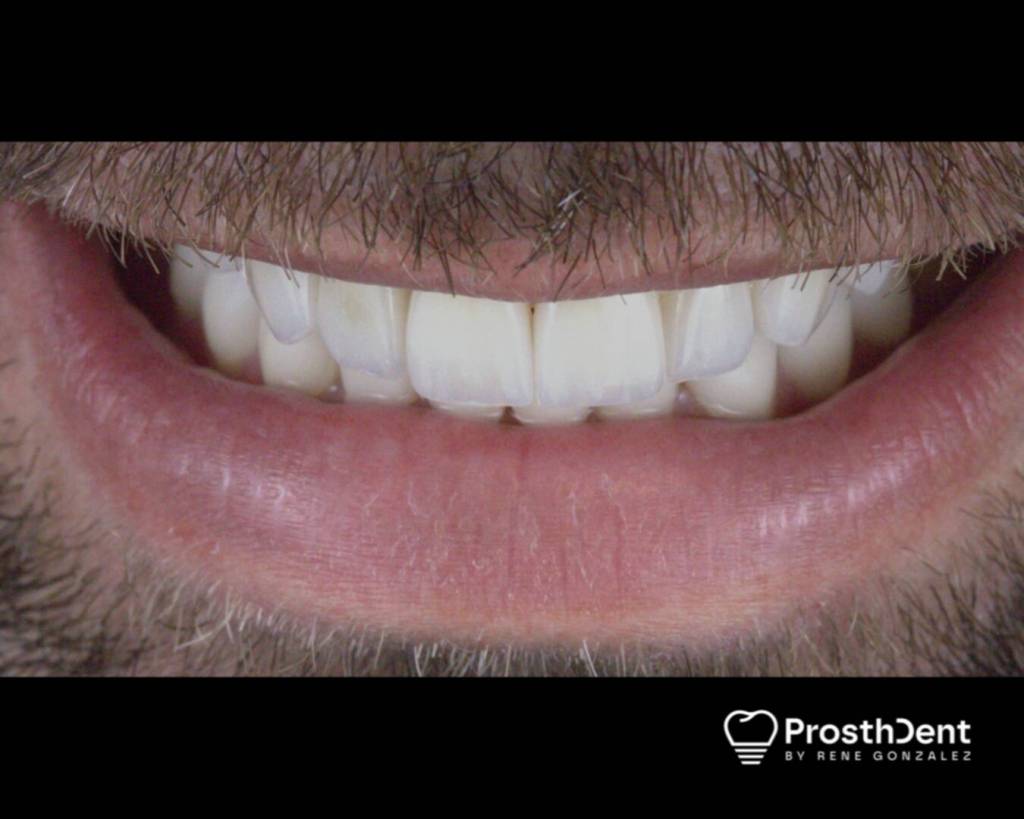 Veneers after photo
