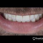 Veneers after photo