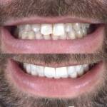Veneers before and after photo