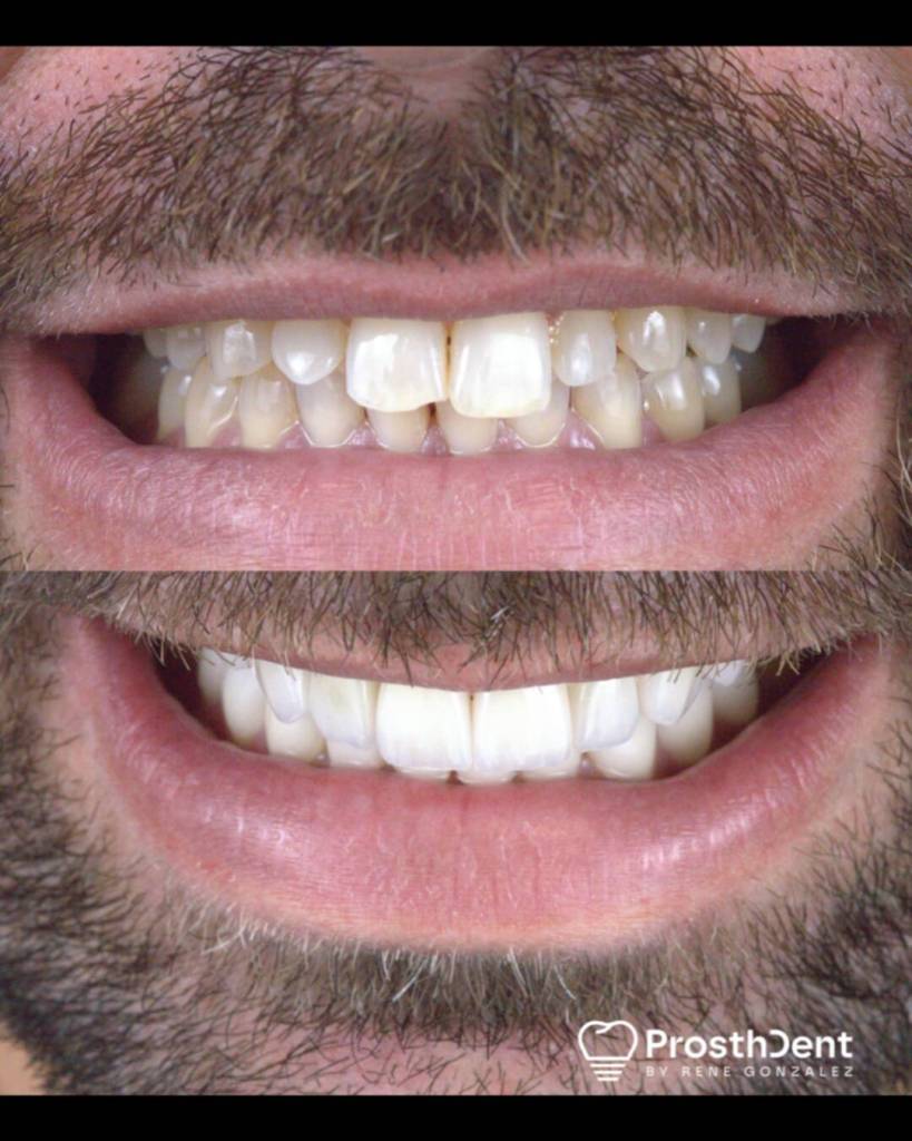 Veneers before and after photo