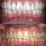 Veneers before and after photo