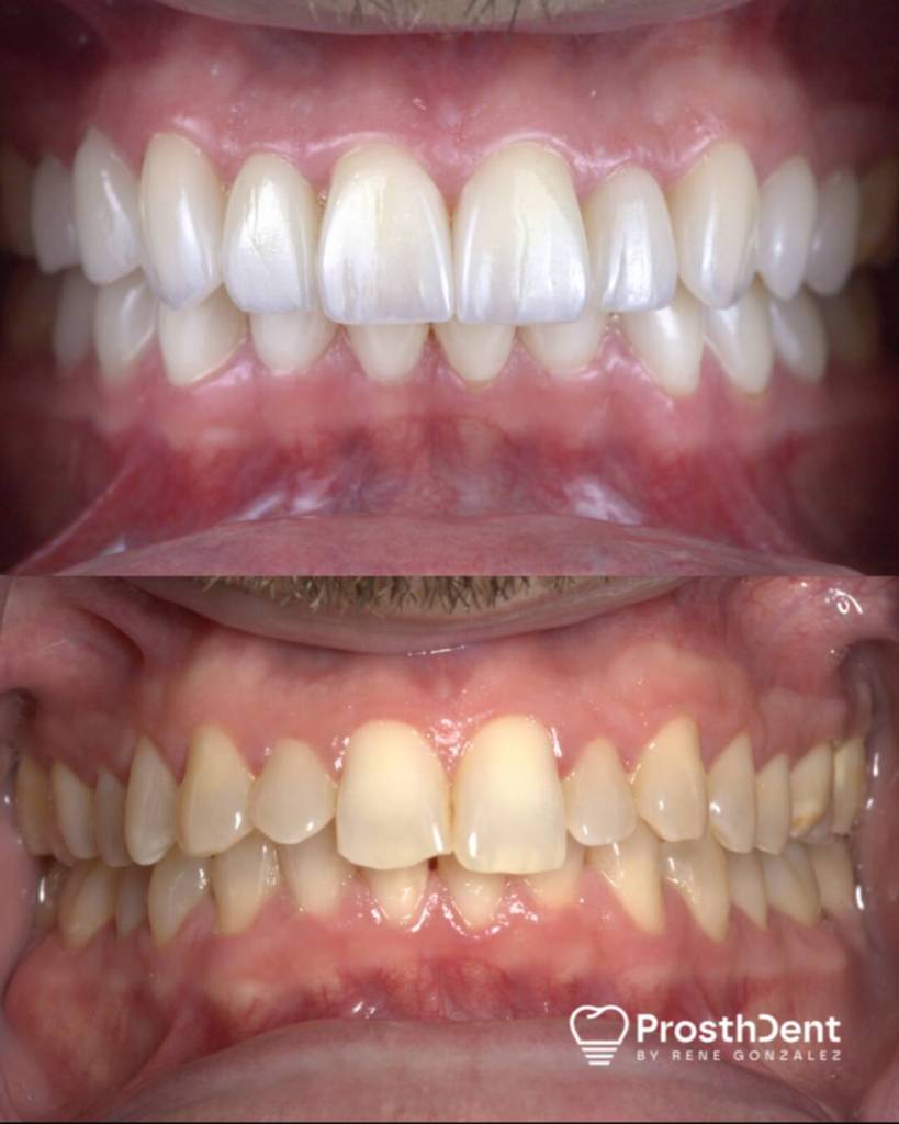 Veneers before and after photo
