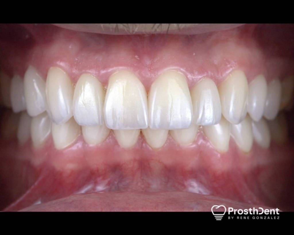 Veneers after photo