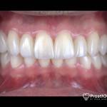 Veneers after photo
