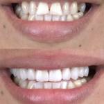 Veneers before and after photo