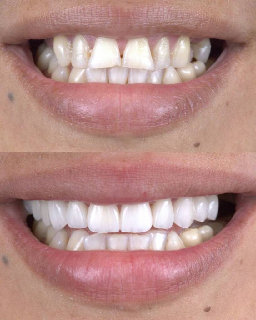 Veneers before and after photo