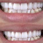 Veneers before and after photo