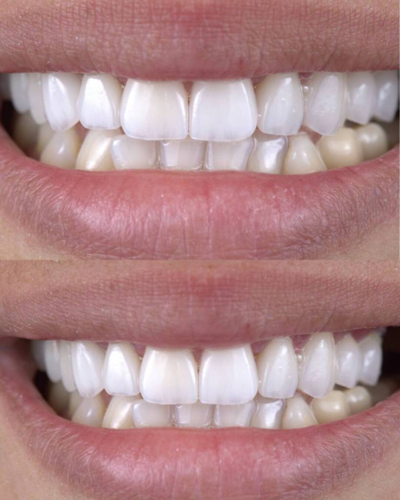 Veneers before and after photo